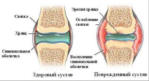 остеартроз