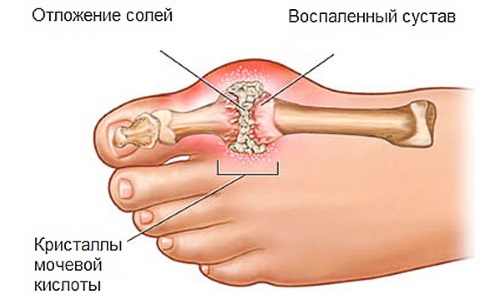 подагра